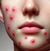 Buy Isotroin capsules (Isotretinoin for Acne) Logo